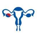 PCOS Treatment in India